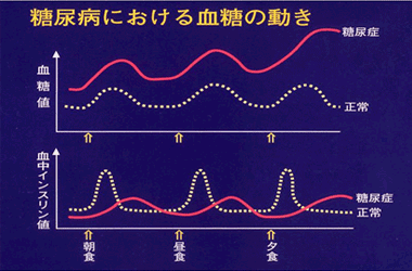 図：糖尿病における血糖の動き